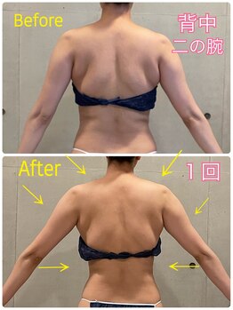 エクセレントビューティーサロン 艶(EN)/ブライダル　お背中集中