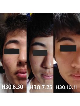 リボーン バイ 中村鍼灸整体院(re born)/ニキビケア男子