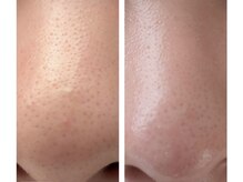 ナナプラス(nana plus)/毛穴ケア