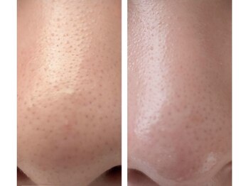 ナナプラス(nana plus)/毛穴ケア