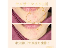 エキュロ 敦賀店(equro)/ニキビケア