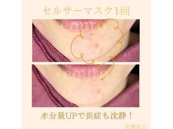 エキュロ 敦賀店(equro)/ニキビケア