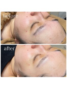 ラクシー 船橋(luxssy)/お顔シェービング×ララピール