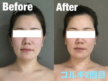 ビーキュート 渋谷北参道店(BE-CUTE)/小顔コルギ2回目 30代