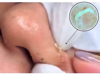 癒える(ielu)の写真/《角質ケア×毛穴ケアで理想の素肌へ◎》お肌に優しいピーリングでお顔全体の角質をケア♪