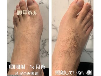 アンジュディ(A'nJUDY)/脱毛ビフォーアフター