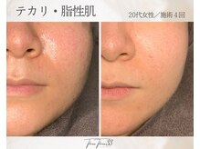 スリースリー(THREE THREE)/テカリ・脂性肌