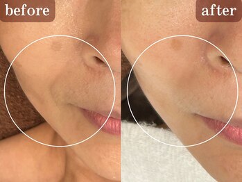 トータルセラピー リッチ(Rich)/40代　ほうれい線改善