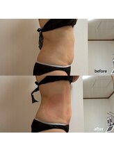 シュシュ(Chou Chou)/脂肪冷却2カップ