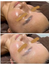 ビオトナス(Facial Esthe)/白玉ホワイトスノーピール