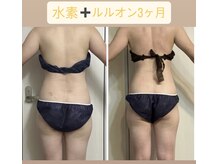 ヨサパーク ハナ 六甲道(YOSA PARK HANA)/水素＋ルルオン3ヶ月見た目重視