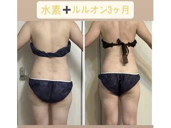 ヨサパーク ハナ 六甲道(YOSA PARK HANA)/水素+ルルオン3ヶ月見た目重視