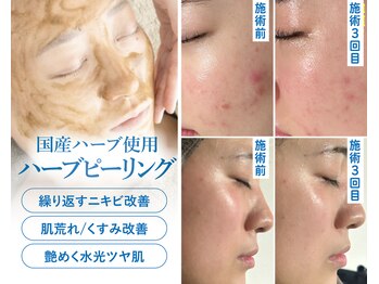 マーミューズ 宮町店&花樹の写真/毛穴・くすみ・ザラつきに！国産ハーブピーリングでお肌の深層部からしっかりケア♪触れたくなる素肌に♪