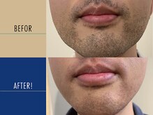 ロペス(Lopez)/【ヒゲ脱毛】10回施術例