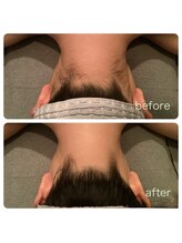 ゲッカ(GEKKA)/うなじ襟足脱毛