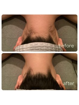 ゲッカ(GEKKA)/うなじ襟足脱毛