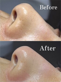 ティーツリー 名古屋 桜山(Tea Tree)/今日もキレイな毛穴誕生