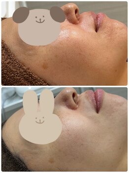 ギャラクシービューティー(galaxy beauty)/光フェイシャル