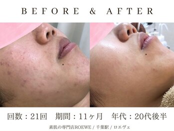 ロエヴェ(ROEWE)/ニキビ改善・毛穴ケア・肌質改善