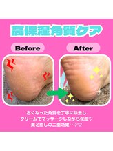 ミニョン レーヴ(Mignon Reve)/【角質ケア】ビフォー/アフター