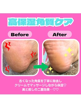 ミニョン レーヴ(Mignon Reve)/【角質ケア】ビフォー/アフター