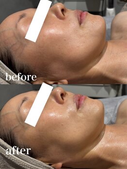 ビーバイビー(BBYB)/プラズマで肌ケアスタート!☆