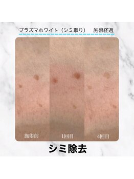 エクラ 六本木(eclat)/プラズマホワイト