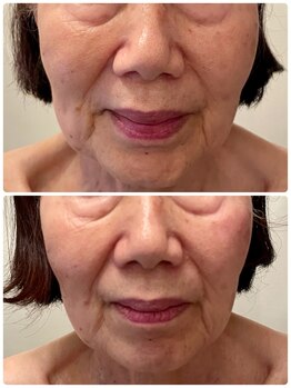 ラ ルミエール(La Lumiere)/70代のたるみにも◎