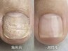 韓国から上陸したジェルで巻き爪ケア1本3300円所要時間30分