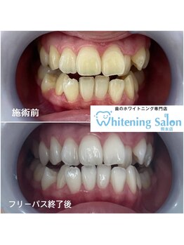 ホワイトニングサロン 熊本店/ 【ホワイトニング施術例】