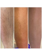 ミライト(MILAIGHT)/メンズ脚脱毛