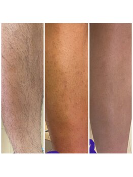 ミライト(MILAIGHT)/メンズ脚脱毛