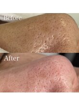 ベルカーラ(Belcarra)/毛穴洗浄ハイドロピーリング