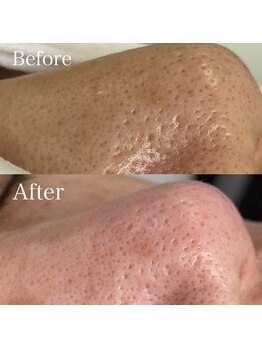 ベルカーラ(Belcarra)/毛穴洗浄ハイドロピーリング