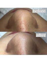 ライカブルー(RaicA BluE)/施術写真　before-after