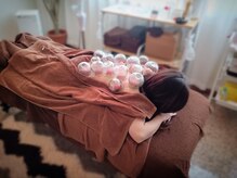 はりキュア(はりCure)/吸い玉療法（留罐）