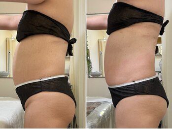 プライベートエステティックサロン クール(Coeur)/【脂肪燃焼/おなかデトックス】