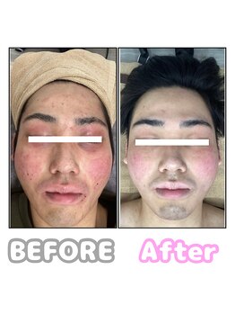 ハリリーナプラス(Haririna PLUS+)/鍼でお肌の土台をつくる