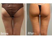 ルナグランデ 心斎橋店(Luna grande.)/内ももスッキリ