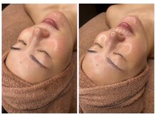 ホワイトアクア 京橋店(WHITE AQUA)/ララピール/大阪/京橋/毛穴