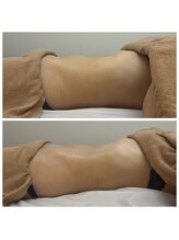 セレア(CELEA)/リンパマッサージ/腸揉み/くびれ