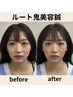 【初回×お試し×驚愕の小顔に】ルート鬼美容鍼　《鍼100本程度》