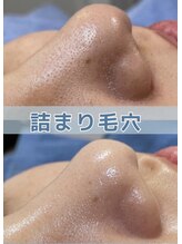 ミャオ(Meow!)/毛穴洗浄/ハイドロスプラッシュ