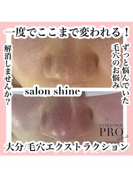 サロンシャイン(Salon Shine)/毛穴エクストラクションプロ