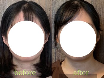アポヨ鍼灸院(APOYO鍼灸院)/小顔　before/after