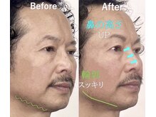ラプリ 横浜店(Raplit)/隆鼻＋輪郭矯正40分