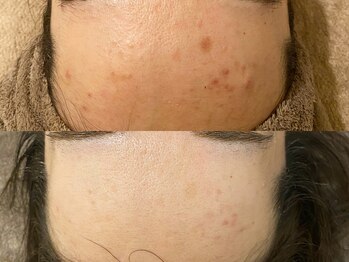 エムフロート(M float)/ハーブピーリング|ニキビ