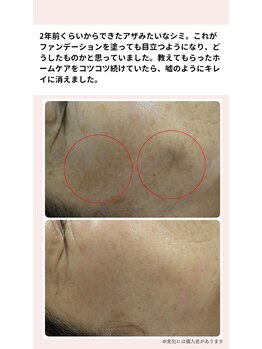 マインドール/アザみたいにあったシミが！