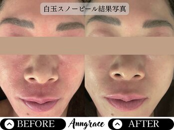 アングレイス(Anngrace)/【本気の肌質改善!】迷子脱却!