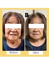 クローバー(clover)/【before/after】施術3回目翌日